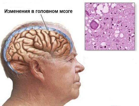 Мозг при сенильной деменции альцгеймеровского типа