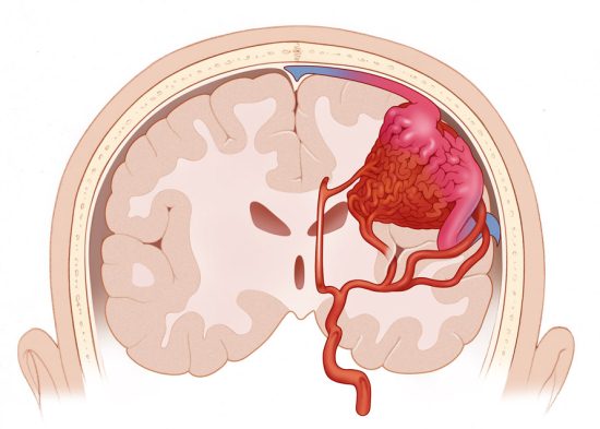 Кровоизлияние в щелевидное пространство между оболочками головного мозга