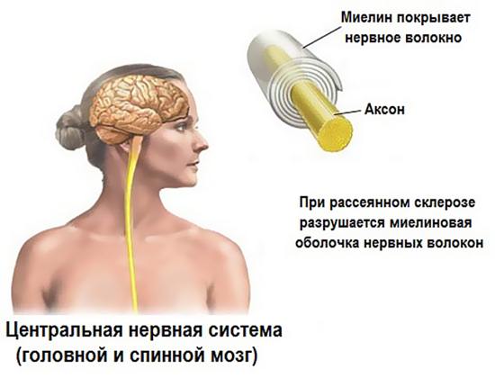 Поражение миелиновой оболочки нервных волокон головного и спинного мозга