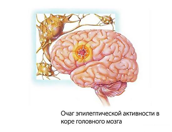 Головной мозг больного, страдающего эпилепсией