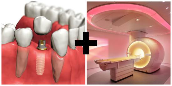 Совместимы ли МРТ и зубные импланты?