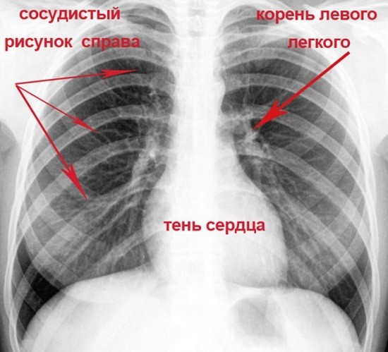 Рентгеновский снимок легких