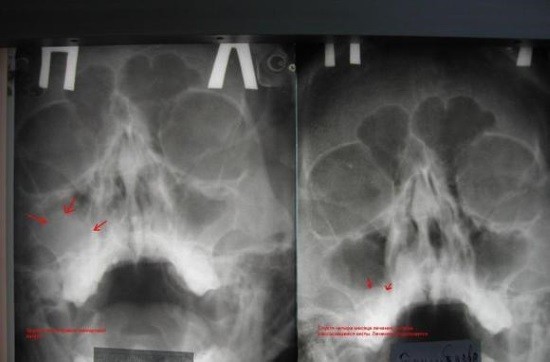 Киста верхнечелюстной пазухи на рентгенограмме