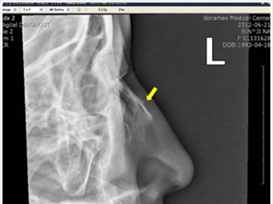Рентгенография при травме носа