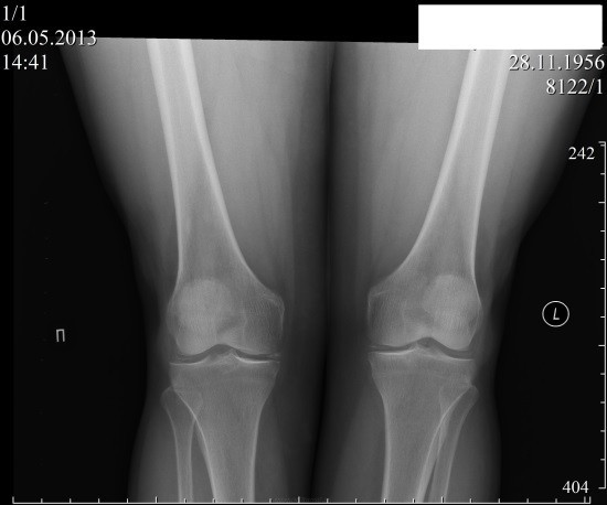 Диагностика патологий коленного сустава не проходит без применения рентгена