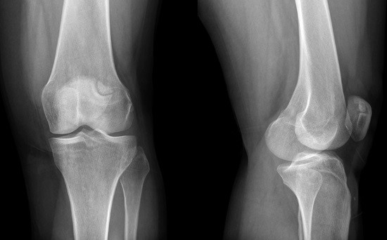 Рентгенография коленных суставов - неинвазивный и информативный диагностический инструмент