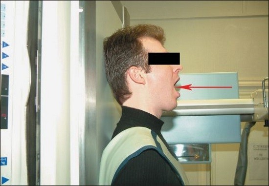 Положение пациента при снимке верхних шейных позвонков