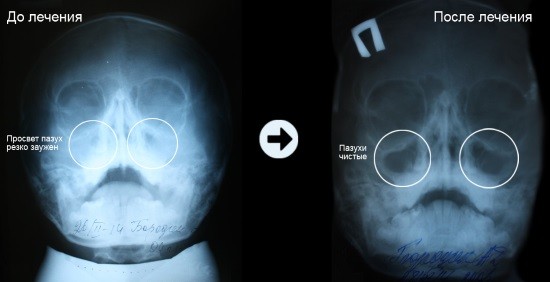 Рентгеновский снимок пазух носа