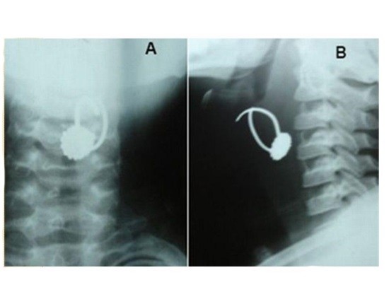 Рентгеновский снимок гортани в двух проекциях