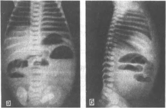 Обзорная рентгенограмма: а — прямая проекция, б — боковая проекция