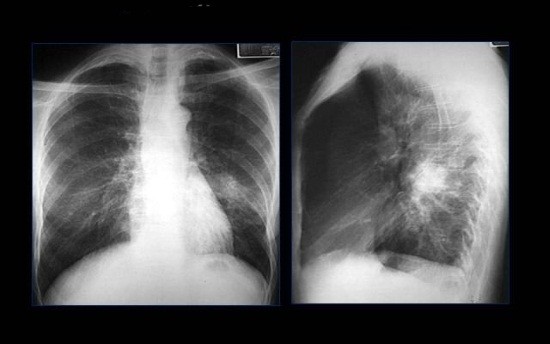 Очаговое затемнение на рентгеновском снимке легких