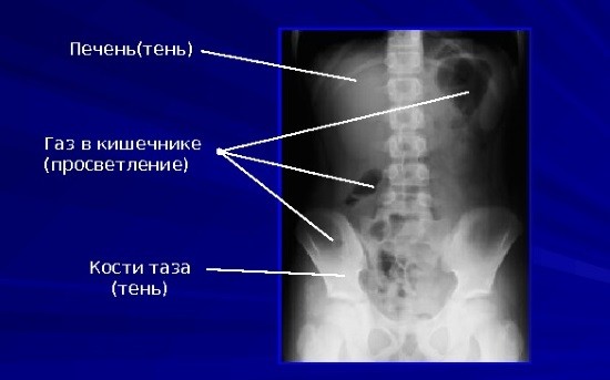 Рентгеновский снимок органов брюшной полости