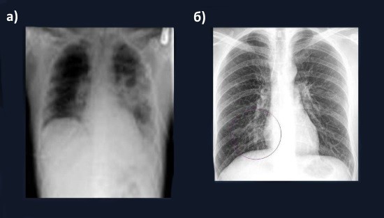 Крупозная пневмония на рентгенгорамме