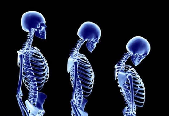 Рентгенография позволяет заподозрить наличие остеопороза по изменению плотности костной ткани