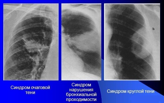 Рентгенограммы при раке легких