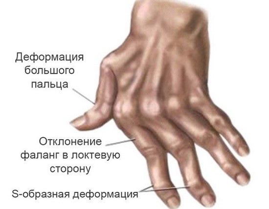 Суставы кистей являются органами-мишенями при ревматоидном артрите