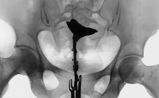 Рентгеновский снимок матки и фаллопиевых труб