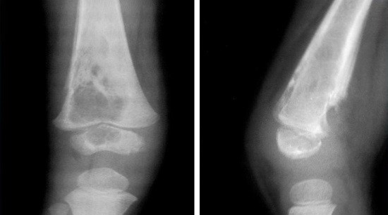 При остеомиелите инфекционный процесс охватывает всю кость, включая костный мозг