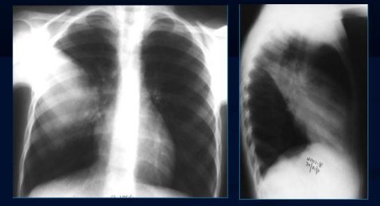 Пневмония на рентгенограмме