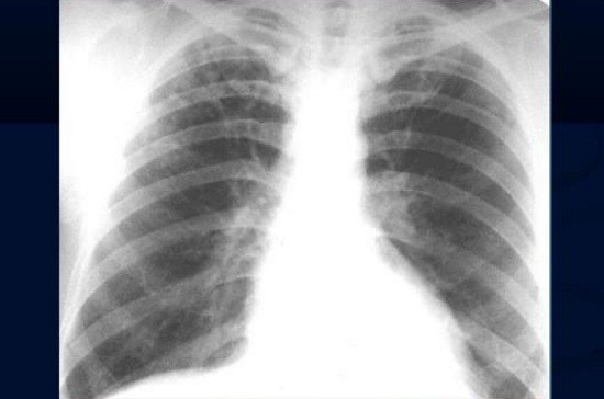 Рентгенограмма при туберкулезе легких
