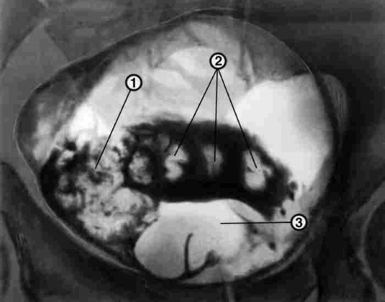 1 — папиллярная опухоль мочевого пузыря; 2 — камни мочевого пузыря; 3 — аденома предстательной железы
