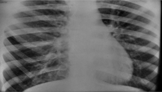 Рентгенограмма легких при эмфиземе
