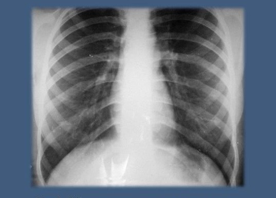 Обзорная рентгенограмма легких