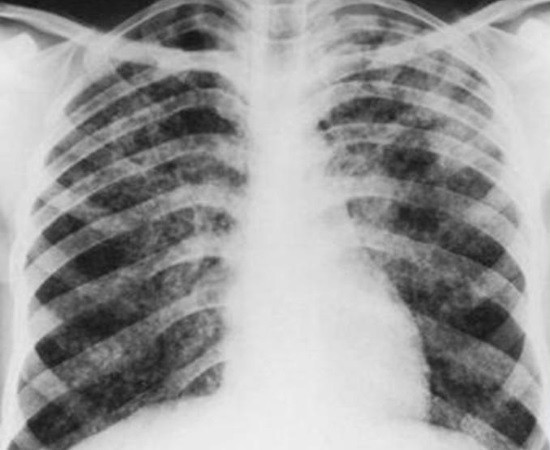 Гематогенно-диссеминированный туберкулез легких