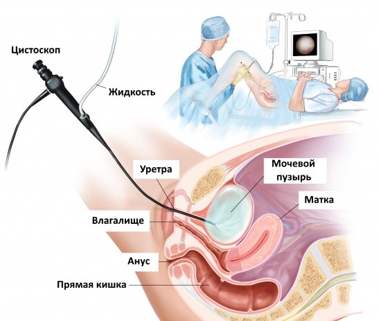 Цистоскопия производится с помощью эндоскопа
