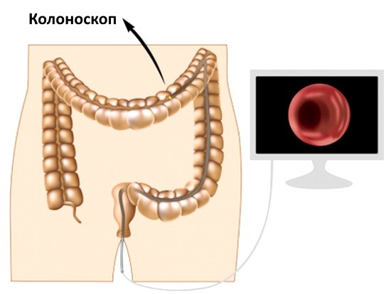 Колоноскопия ─ современный метод диагностики патологий толстого кишечника
