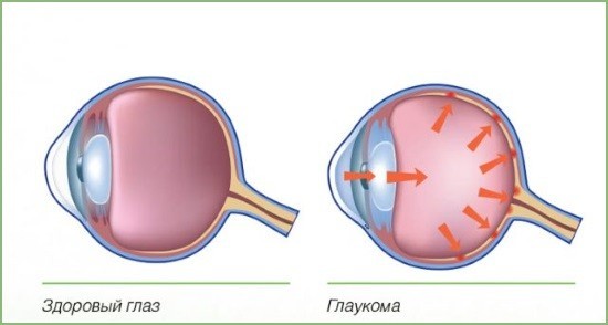 Норма и глаукома