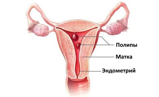 Гистерскопия показана при полипах матки