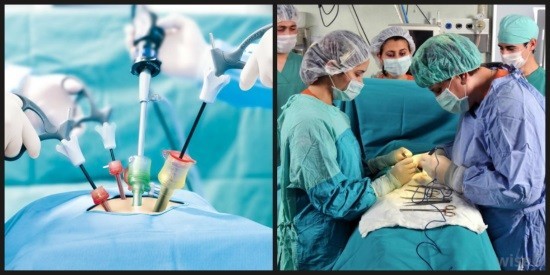 Лапароскопия и полостная операция