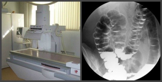 Ирригоскопия относится к рентгенологическим методам исследования