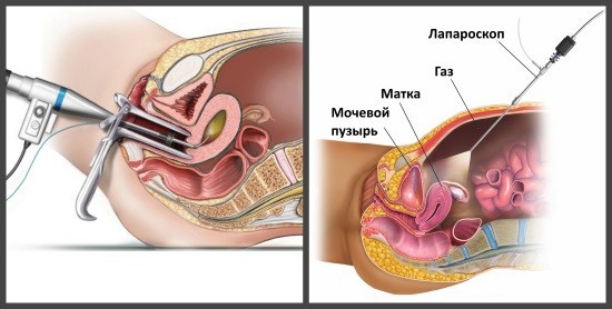 Эндоскопические исследования матки и придатков