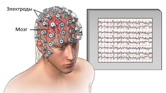 Электроды располагают на поверхности головы