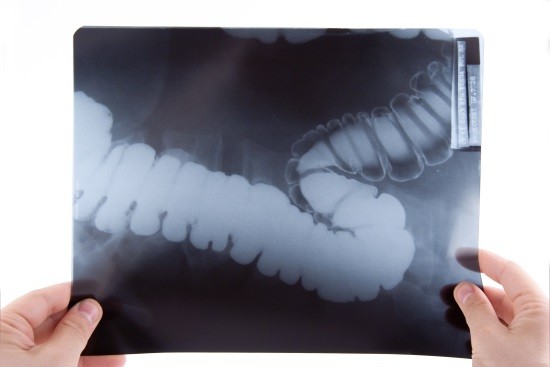 Рентгеновский снимок кишечника