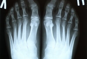 Рентгенография ноги (стопы) – быстрая и безопасная диагностика