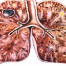 Роль компьютерной томографии в диагностике туберкулеза легких и внелегочной локализации