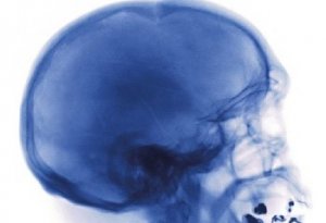 Компьютерная томография черепа: показания, возможности диагностики