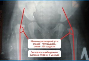 Рентген тазобедренного сустава в детском возрасте