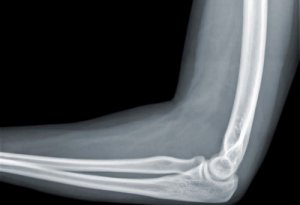 Рентген-исследование локтевого сустава