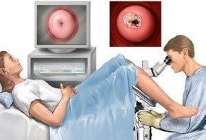 Кольпоскопия для диагностики и лечения заболеваний шейки матки