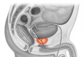 МСКТ предстательной железы в диагностике простатита и онкологических процессов