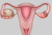 Удаление эндометриоидной кисты яичника путем лапароскопии