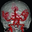 Церебральная ангиография – актуальный метод диагностики сосудов головного мозга
