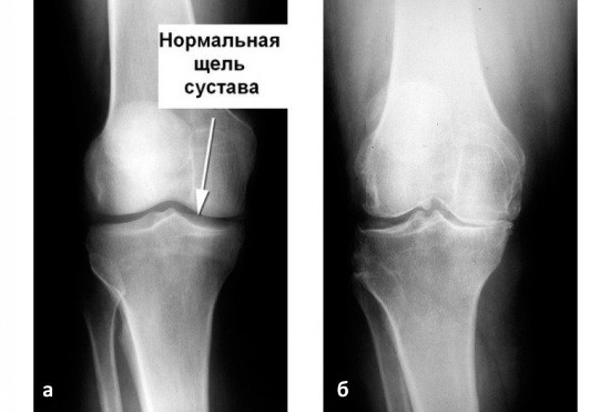 Артроз коленного сустава рентген или узи thumbnail