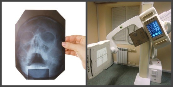 Снимки околоносовых пазух могут быть сделаны на цифровом или пленочном рентген-аппрате