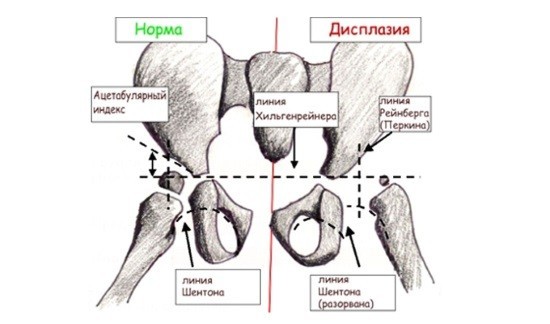 Изображение - Рентген снимок тазобедренного сустава норма rentgen-tazobedrennogo-sustava-v-detskom-vozraste
