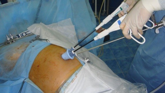 Лапароскопия относится к малоинвазивной хирургии